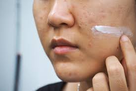 retinoid cream for acne