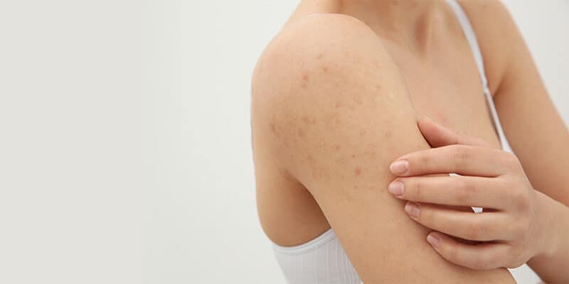 shoulder acne treatment